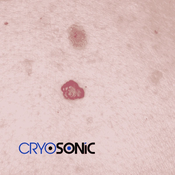 Looking for pain free cherry angioma removal treatment Corby? Call our team today! Corby