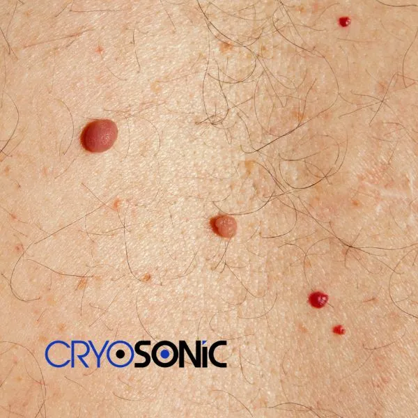 get cherry angioma removal treatment today! Corby