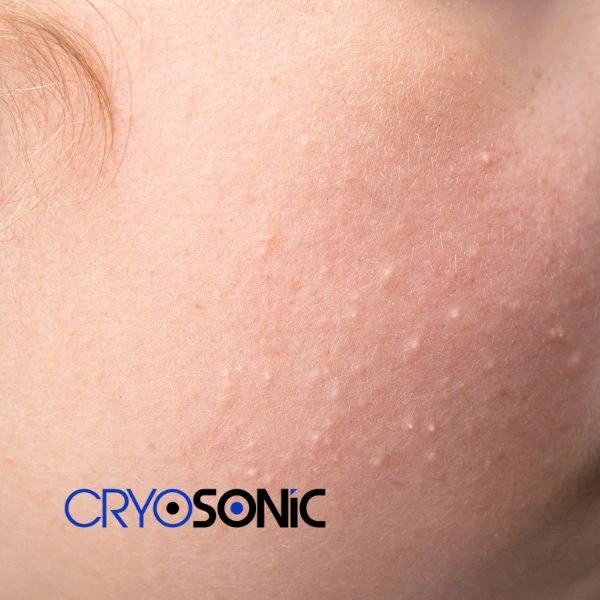 Are you looking for milia removal treatment? Contact our team today Corby
