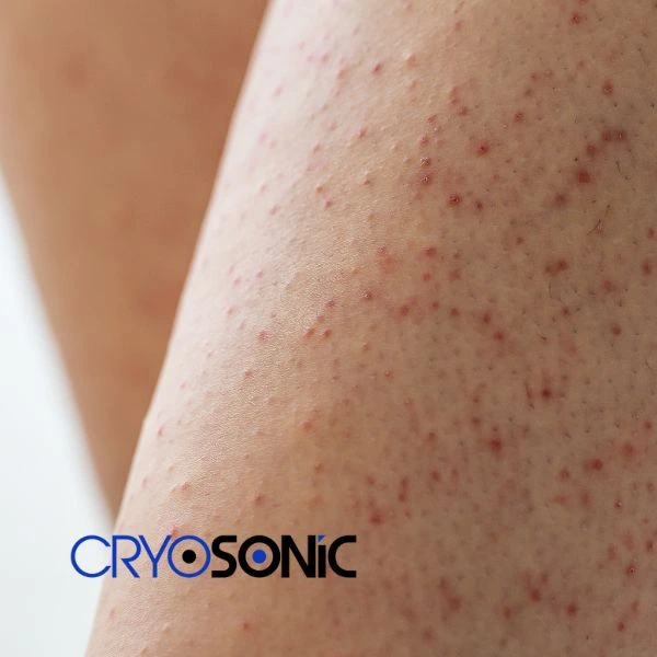 Looking for Seborrhoeic Keratosis removal Corby treatment? Call our consultants today in Corby