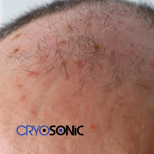 Access Seborrhoeic Keratosis removal from the comfort of your own home! Call us today in Corby