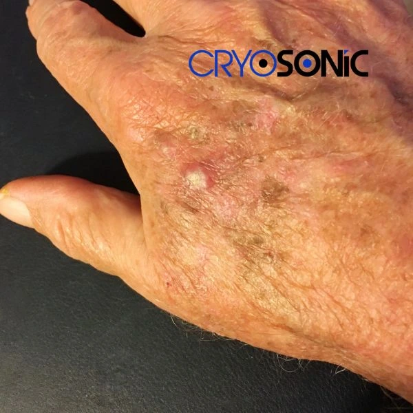 Understand more about actinic keratosis treatment today Corby