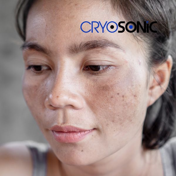 Ready to start age spots removal? Contact our team today in Corby