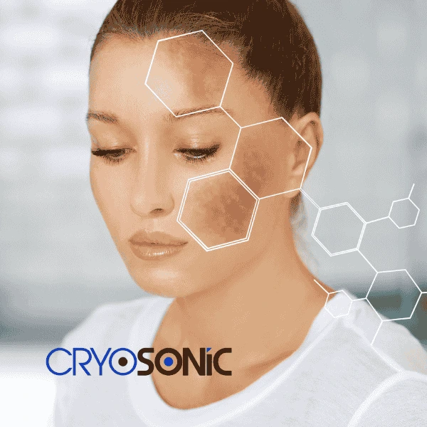 Are you looking for age spot removal treatment? Contact Cryosonic today in Corby