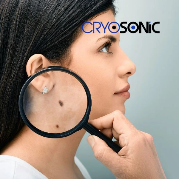 Do you want to learn more about benign moles removal treatment? Call our team today Corby