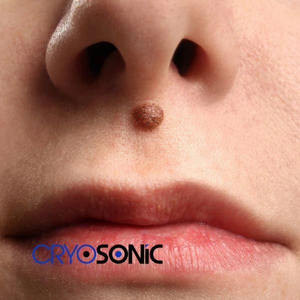 Start your benign moles removal treatment today Corby