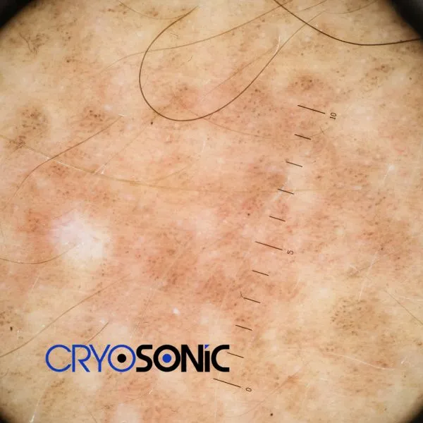 Speak to our team today about sun damaged skin treatment today in Corby