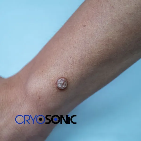 Deep Verrucae removal treatment possible from your own home! Book treatment today Corby