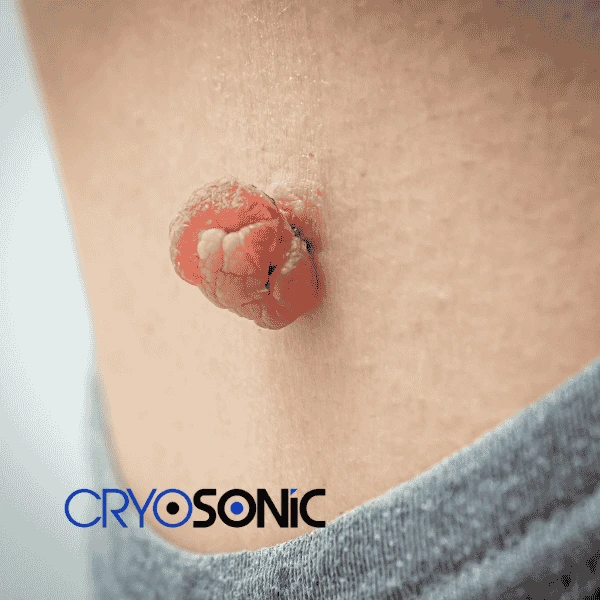 Book your skin tags removal Corby from comfort of your own home! Corby