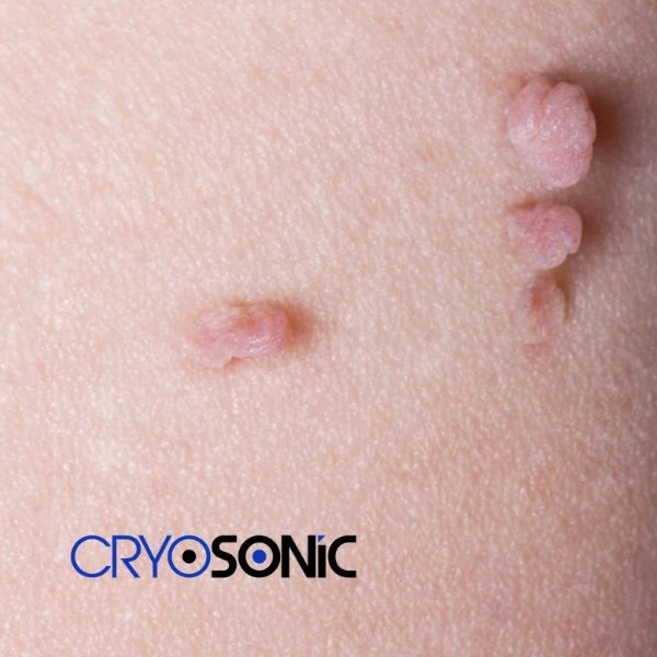 Are you looking for fast effect skin tag removal Corby? Book in NOW! Corby