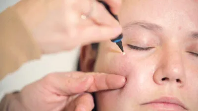 CryoPen device treating milia Corby cysts on the skin safely and precisely Corby