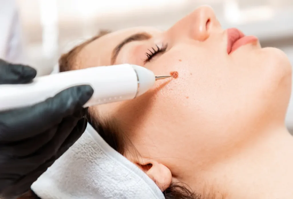 CryoPen Accuracy Corby being used to safely and precisely remove multiple skin lesions, illustrating answers to common patient FAQs Corby