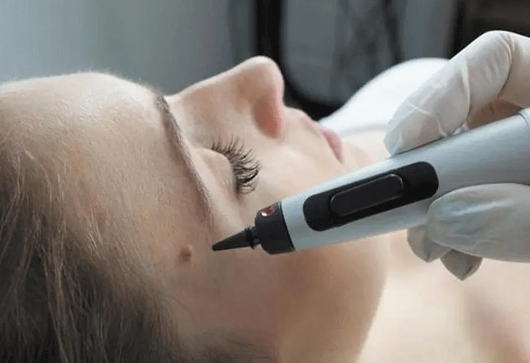 CryoPen accurately targeting skin lesions with millimetre-precision for safe and effective removal by Cryosonic Corby