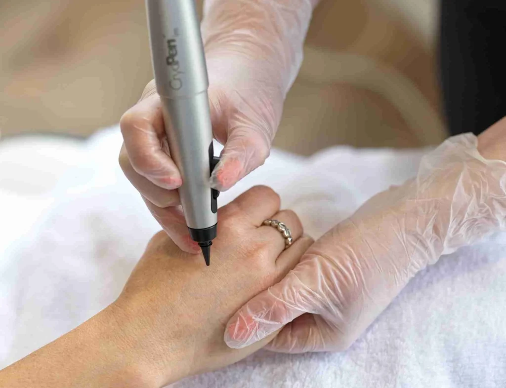 CryoPen Accuracy Corby in action, precisely targeting a skin lesion to ensure safe treatment and protect surrounding healthy skin Corby