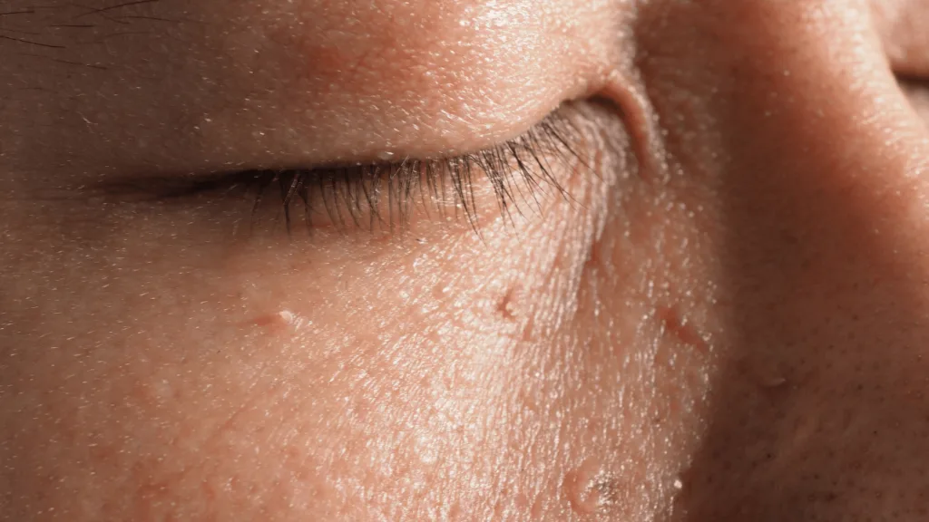 CryoPen removing Skin Tags Corby with precision, showing safe and controlled ablation for smooth, clear skin by Cryosonic Corby
