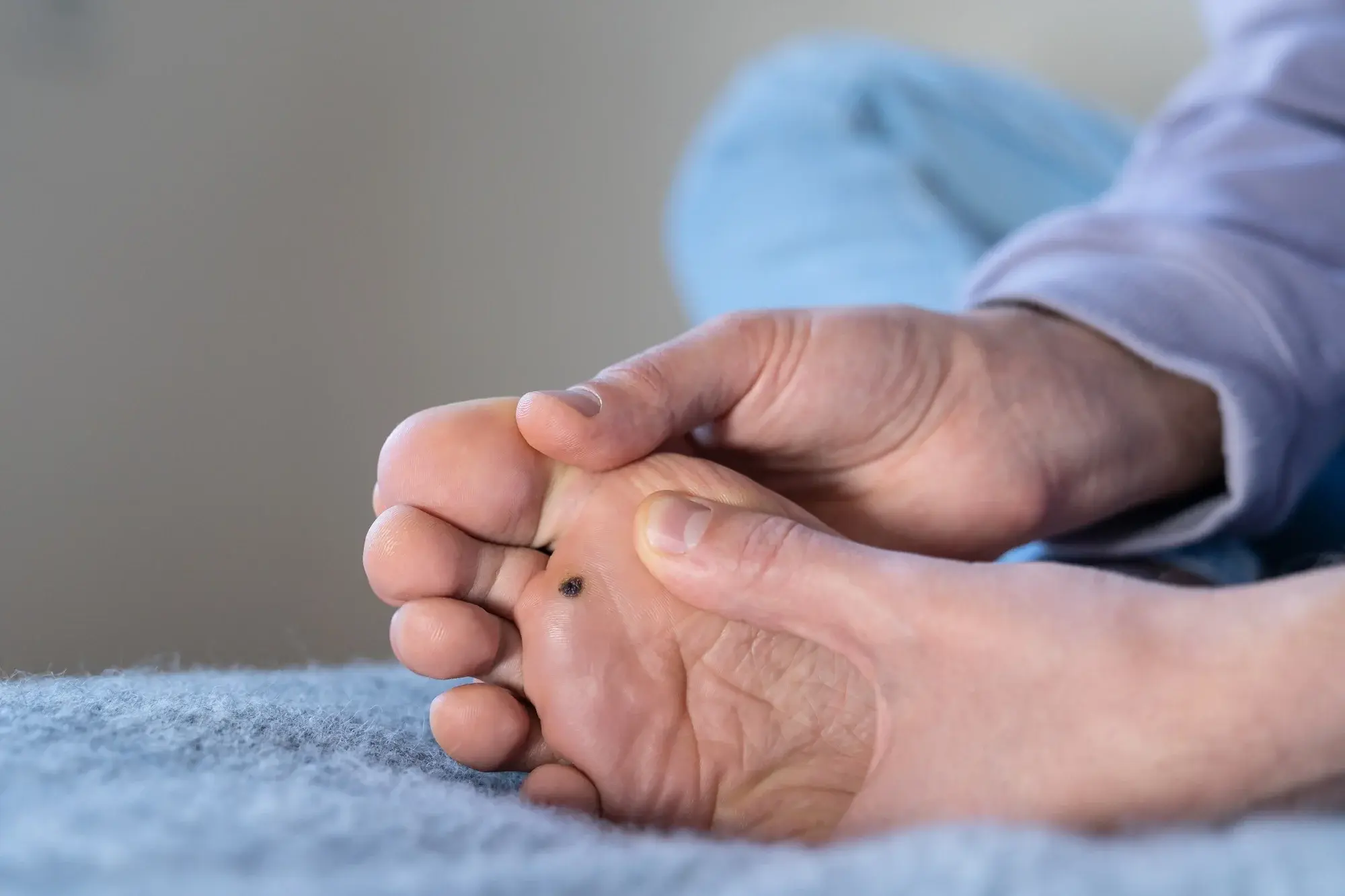 CryoPen treatment for multiple and stubborn Plantar Warts (Verrucae) Corby, showing safe, precise removal and patient-friendly procedure Corby