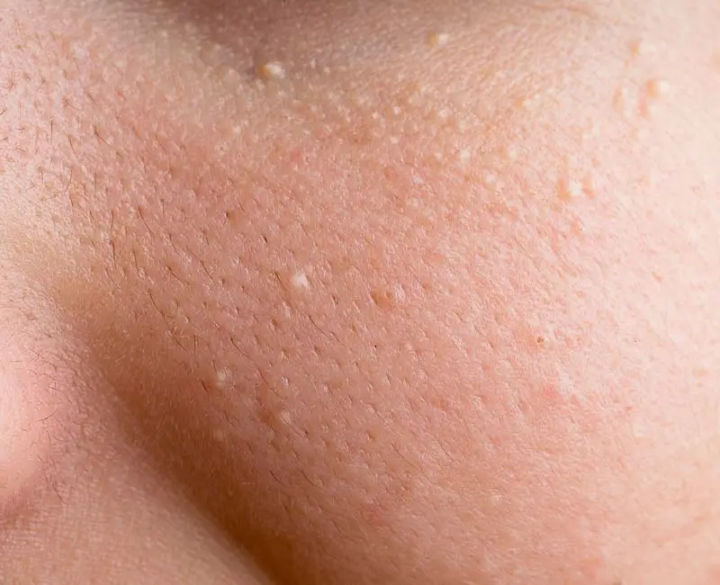 Milia keratin-filled cysts treated with CryoPen for safe scar-free removal Corby