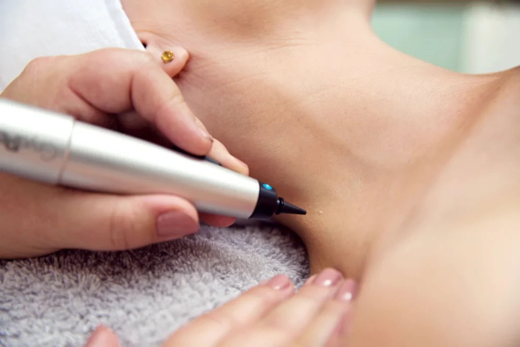 CryoPen precisely treating Molluscum Contagiosum lesions, showing safe and effective removal for faster healing by Cryosonic Corby