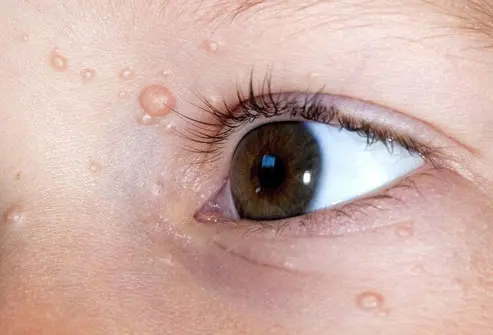 CryoPen treating persistent Molluscum Contagiosum Corby lesions Corby