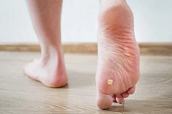 CryoPen treatment removing stubborn Plantar Warts (Verrucae) for precise, safe, and effective relief from resistant lesions Corby