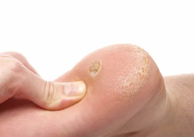 Painful Plantar Warts (Verrucae) Corby, highlighting how stubborn warts affect everyday activities and comfort Corby