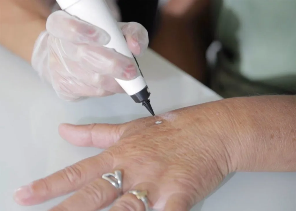 Close-up of CryoPen accuracy Corby targeting a skin lesion, showing why precision matters for safe and effective removal Corby