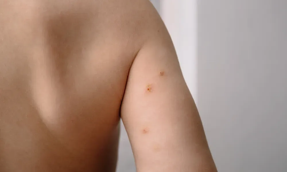 CryoPen treating Molluscum Contagiosum Corby professionally, highlighting safe and precise lesion removal for improved skin and confidence Corby