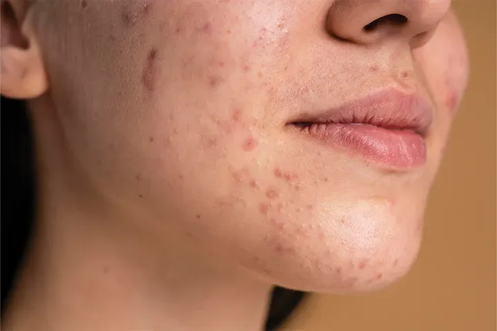 CryoPen precisely removing Skin Tags (fibroepithelial polyps), showing safe and effective treatment for smoother, clearer skin Corby