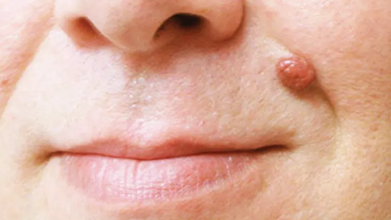 CryoPen safely removing Skin Tags Corby, showing minimal recurrence risk and precise treatment for smoother, clear skin by Cryosonic Corby