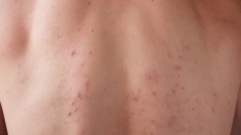 CryoPen treating Corby Molluscum Contagiosum lesions safely and precisely, illustrating answers to common patient FAQs Corby