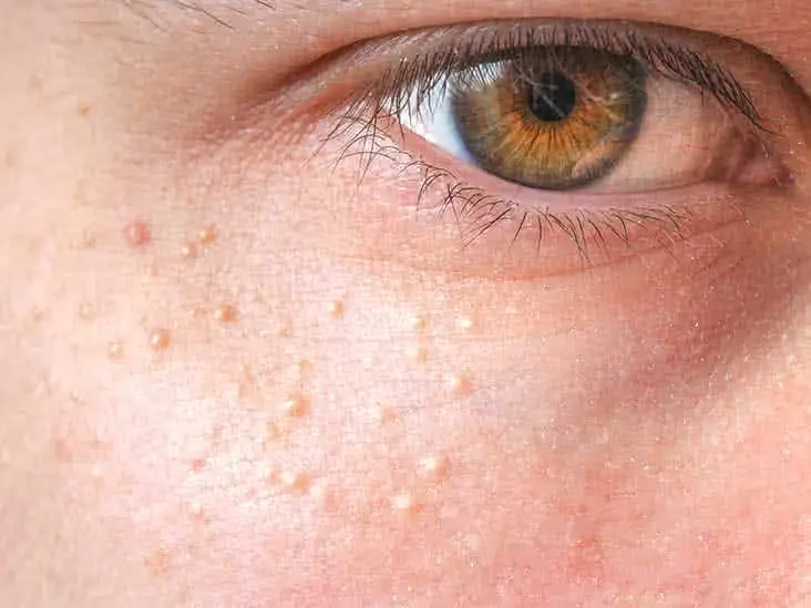 Close-up of skin showing milia Corby, small keratin-filled cysts on the face Corby