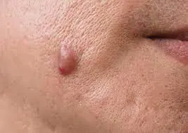 common causes of Skin Tags Corby formation, including friction, genetics, and hormonal changes Corby